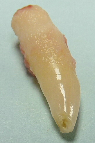 extracted tooth